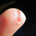 Cicatrización de cortes en el dedo
