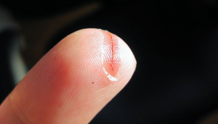 Cicatrización de cortes en el dedo | Consejos de alimentación para una rápida recuperación