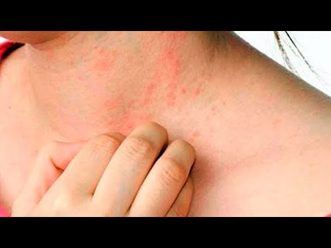 Síntomas de intoxicación por hígado en la piel